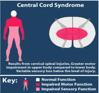 Gambar. Central cord syndrome.