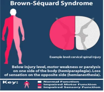 Gambar. Brown sequard syndrome.