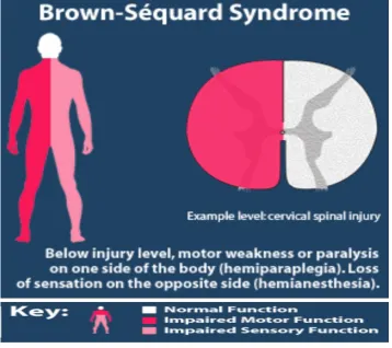Gambar. Brown sequard syndrome.