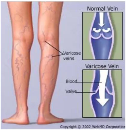 Gambar 1. Varicose Veins11 