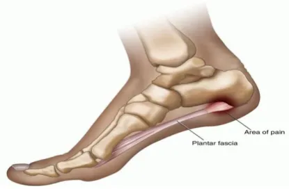 Gambar 3. Plantar Fasciitis 20