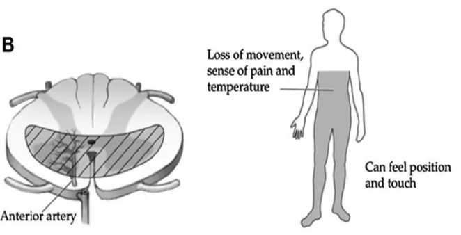 Gambar 5. Anterior Cord Syndrome(Dikutip dari: Amstrong et all: 2014)