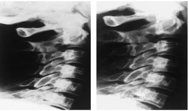 Gambar 10. X-ray Menunjukkan Cedera Tulang Belakang