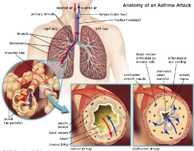 Gambar 1. Asma bronchiale 8