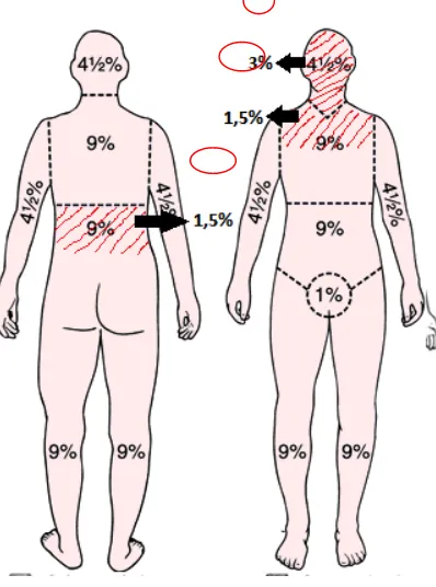 Gambar 1. Total Body Surface pada pasien 