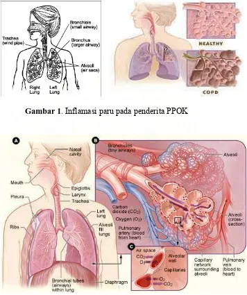 Gambar 1. Inflamasi paru pada penderita PPOK 