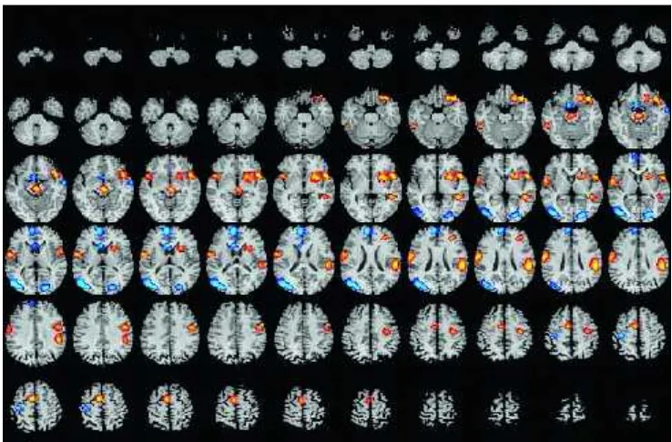 Gambar 1. Aktivasi (Area Kuning-Merah) dari Struktur Otak Dinilai dengan Rata-Rata Fungsional MRIBersamaan dengan Stimulasi Kemosensorik Trigeminal Nasal2