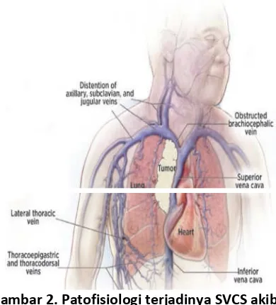 Gambar 2. Patofisiologi terjadinya SVCS akibat