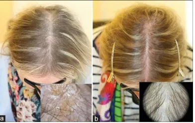 Gambar 1. (a) Pasien dengan defisiensi biotin (alopesia dan dermatitis seroboik) ; (b) Setelah pengobatan suplementasi biotin 5 mg oral selama 3 bulan17 