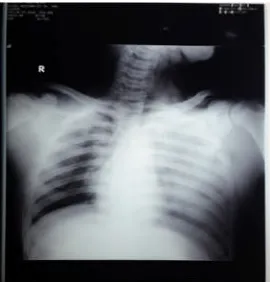 Gambar 1. Rontgen Toraks AP