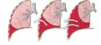 Gambar 2. Klasifikasi hematotoraks.11