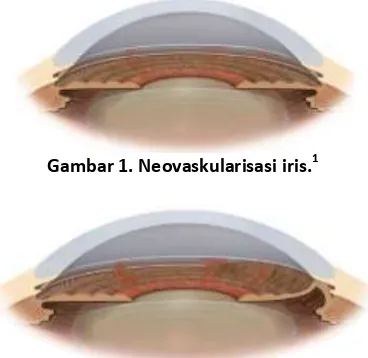 Gambar 1. Neovaskularisasi iris.1 