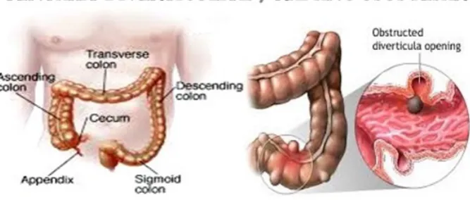Gambar 2.1.1 Diverticular disease