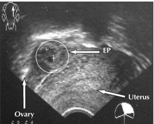 Gambar 11. USG kehamilan ektopik 