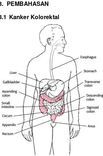 Gambar 1. Letak Kanker Kolorektal.[6] 