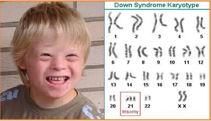 Gambar 2. Terjadinya Trisomi 21 Pada Penderita Sindrom Down