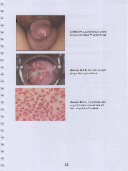 Gambar IV.La. Duh tubuh uret ra dengan penyebab N. gonorrhoeae 
