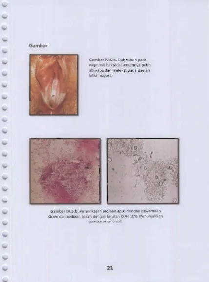 Gambar Gambar IV.S.a. Duh tubuh pada vaginosis baktenal umumnya putih 