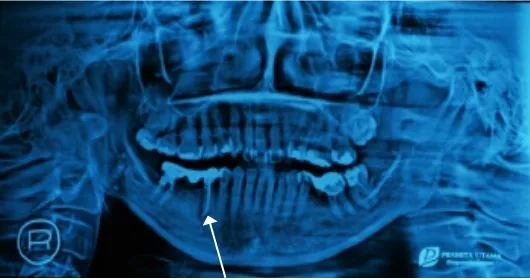 figure �. Tooth 45 within crown and bridge before endodontic treatment (arrow).