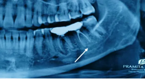 figure ��. At three month later, the radiographic showed that there was alveolar bone gain (arrow).