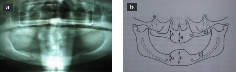 Figure 1. The intra-oral condition of the patient: a) Maxilla and mandible; b) Flabby tissue and mandibular candidiasis in the anterior mandible.