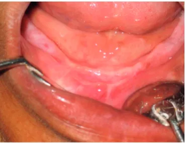 Figure 3. The seperated alveolar ridge was fixated with  T-plate screwed and tied with a ligature wire.