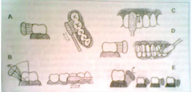 Gambar 2.1 Berbagai metode menyikat gigi, A. Horisontal, B. Bass, C. Leonard,          D