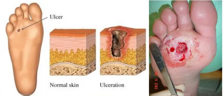Gambar 2.1 Perbedaan antara jaringan kulit normal dan jaringan yang terkena