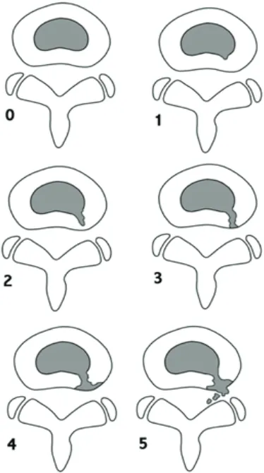 Figure 5. The classification of internal disc disruption from grade 0 to grade 5, based on the Modified Dallas Classification.(30) (Adapted with permission from John Wiley & Sons, Inc).
