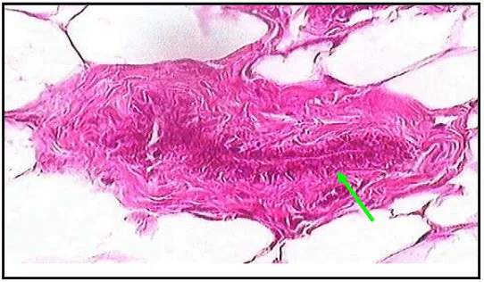 Gambar 4.2. Pengamatan mikroskopis kelenjar mammae kelompok perlakuan I (HE, 40x10), tanda panah menunjukkan adanya hiperplasia pada sel epitel kelenjar mammae dan proliferasi yang berat