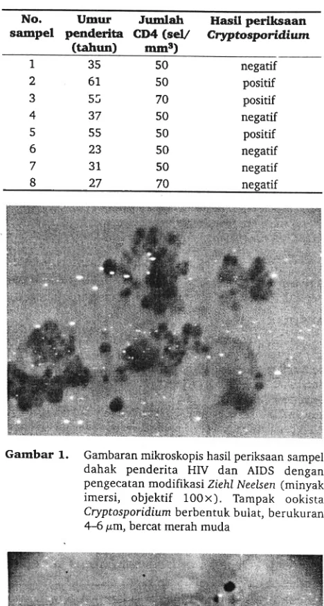 Gambar 1. Gambaran mikroskopis hasil periksaan sampeldahak penderita HIV 