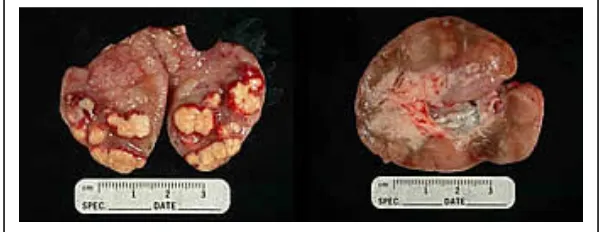 Gambar 1. Limfoglandula sapi yang terinfeksi tuberkulosis (kiri), Limfoglandula sapi normal (kanan) Sumber: STATE OF MINNESOTA (2008) 