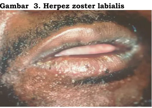 Gambar  3. Herpez zoster labialis 