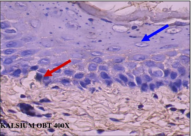 Gambar 5.21:  Gambaran ekpresi kalsium intrasel pada biopsi gingiva mencit (obat) dengan pulasan metode immunohistokimia 