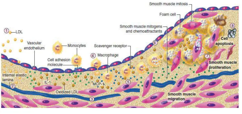 Gambar 2.1 Skema patologi evolusi plak aterosklerosis. (Diadaptasi dari Zipes D, 