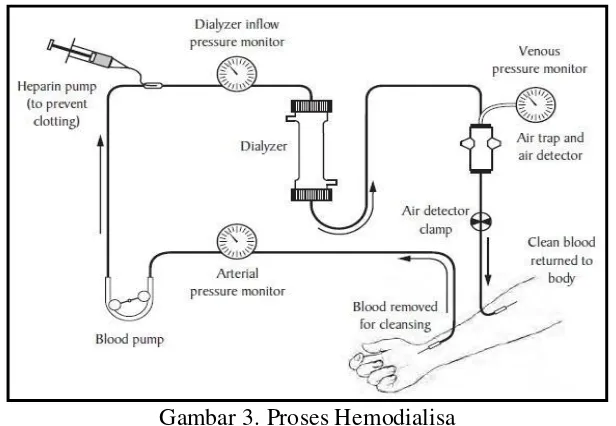 Gambar 3. Proses Hemodialisa 