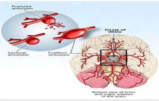 Gambar 2.3  Pendarahan Stroke Subarakhnoid (Medicinenet, 2011) 
