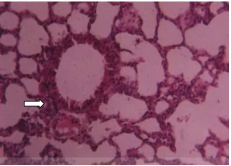 Gambar 2.7 Gambaran histologis organ paru tidak normal yang terdapat nodul 