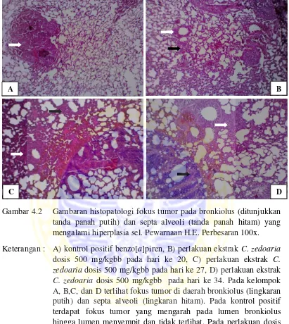 Gambar 4.2    Gambaran histopatologi fokus tumor pada bronkiolus (ditunjukkan 