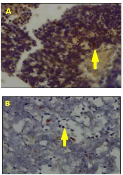 Figure 3. Immunohistochemical determination of p53 in a well differentiated (A) and a poor differentiated (B) retinoblastoma sample