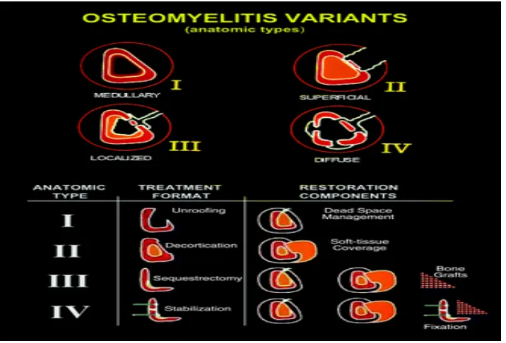 Gambar 1. Dikutip dari Cierny G III: Chronic osteomyelitis: Results of treatment.  Instr Course Lect 1990;39:495-508.