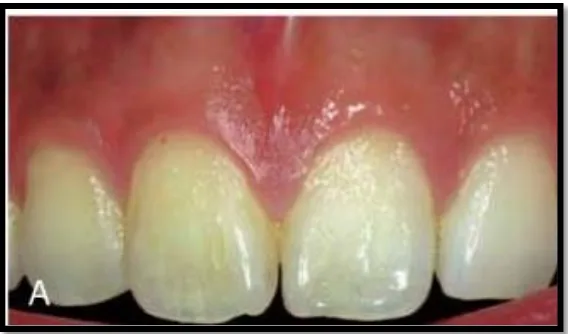 Gambar 1. Gambaran klinis gingiva sehat.21