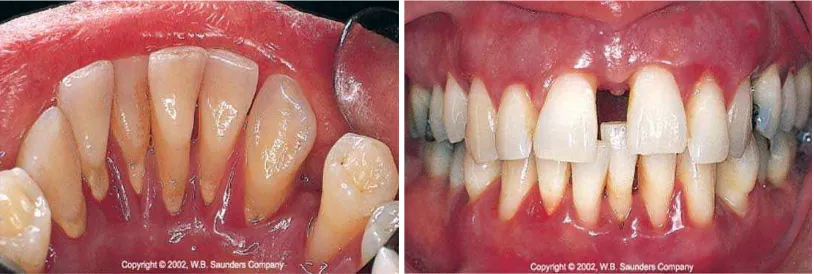 Gambar 2. Gambaran klinis periodontitis kronis.2 