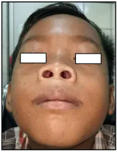 Gambar 3. Septum Nasi dalam Batas Normal