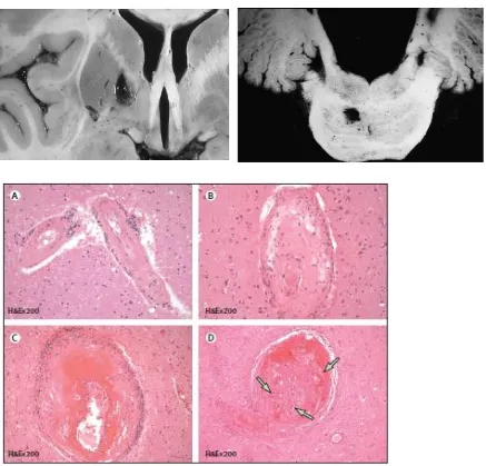 Gambar 4.2 Tampilan histologis dari arteriol dengan patologi SVD, dari arteriolosklerosis dini ke nekrosis fibrinoid