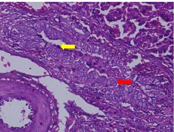 Gambar 4.3 Cholangitis hepar ayam pedaging. Terdapat cholangitis pada perlakuan hari ke-21 pasca infeksi, ditandai dengan adanya sel radang (            ) proliferasi epitel (         ) dari duktus biliaris