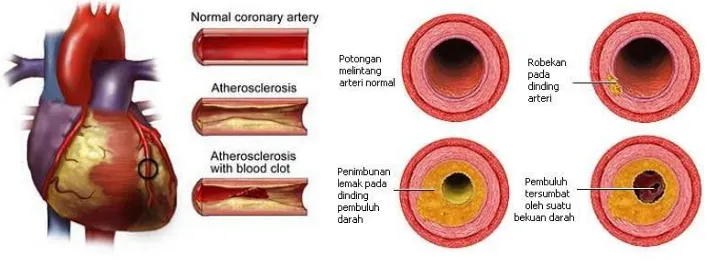 Gambar 2.2 Proses Terbentuknya Aterosklerosis  