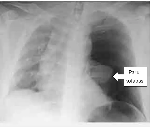 Gambar 2. Gambaran radiologi Pneumothorak ventil dikutip dari 1 