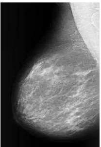 Gambar 2.8 Citra Grayscale Mammografi (Database MIAS) 