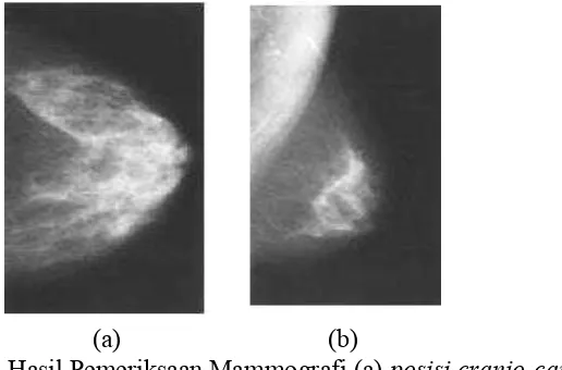 Gambar 2.3 Pemeriksaan Menggunakan Mammografi (Santoso dkk., 2008). 